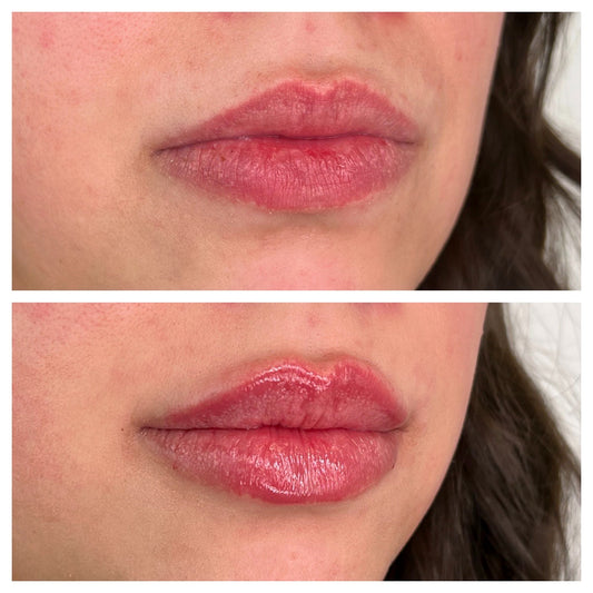 Hyaluran Lip Fillers