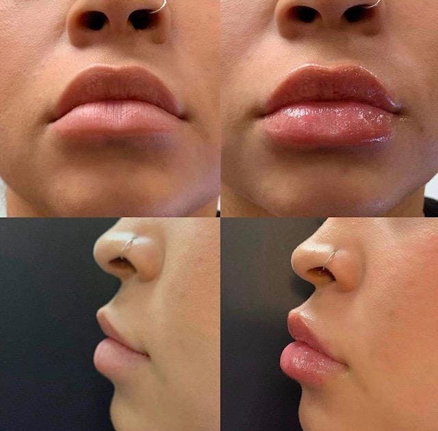 Hyaluran Lip Fillers
